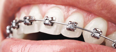 ortodontinis-gydymas-psl